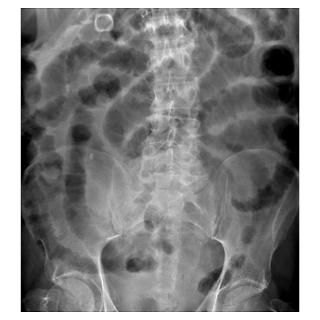 Wall Art  Posters  Small bowel obstruction, X ray